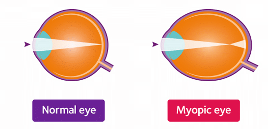 myopia diagram