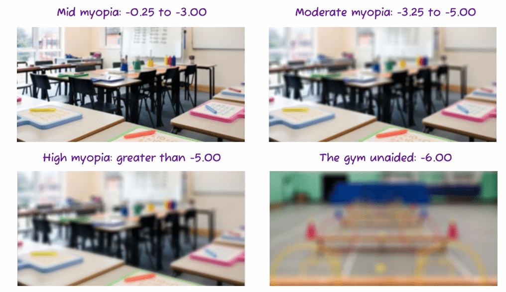 myopia example